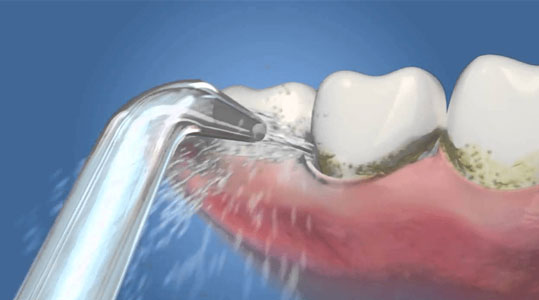 Mejor irrigador dental periodontitis